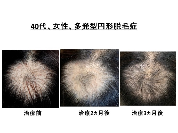 円形脱毛症　病院